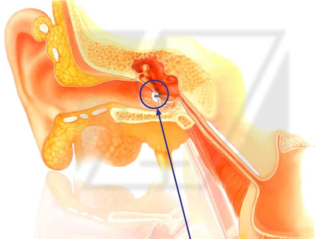 Oido con drenajes Oido con drenajes